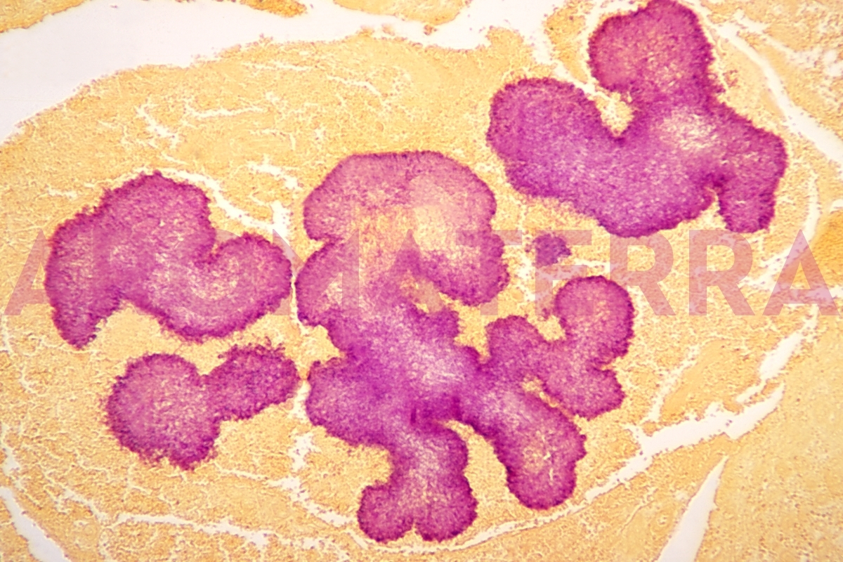 psorijaza prirodno liječenje prirodni lijekovi ljekovito bilje eterična ulja